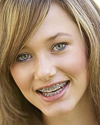 photo of a teenage girl with braces
